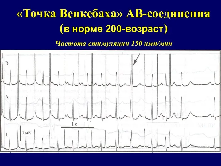 «Точка Венкебаха» АВ-соединения (в норме 200-возраст) Частота стимуляции 150 имп/мин