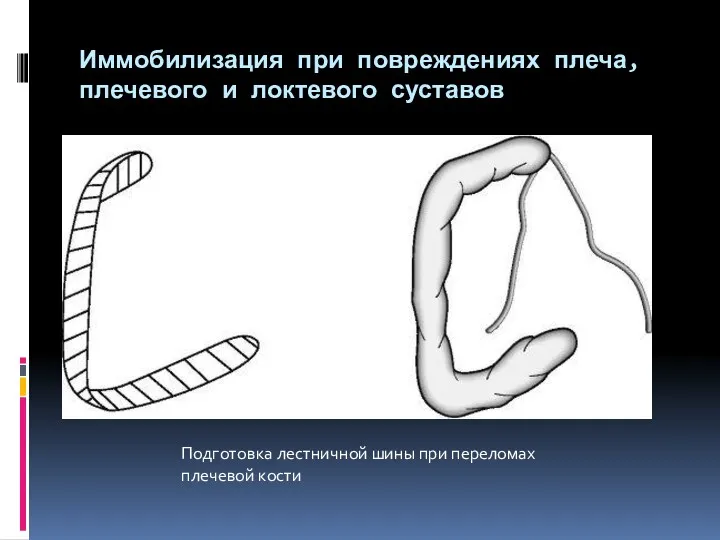 Иммобилизация при повреждениях плеча, плечевого и локтевого суставов Подготовка лестничной шины при переломах плечевой кости