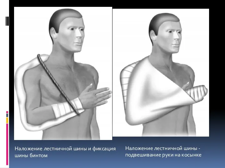 Наложение лестничной шины - подвешивание руки на косынке Наложение лестничной шины и фиксация шины бинтом