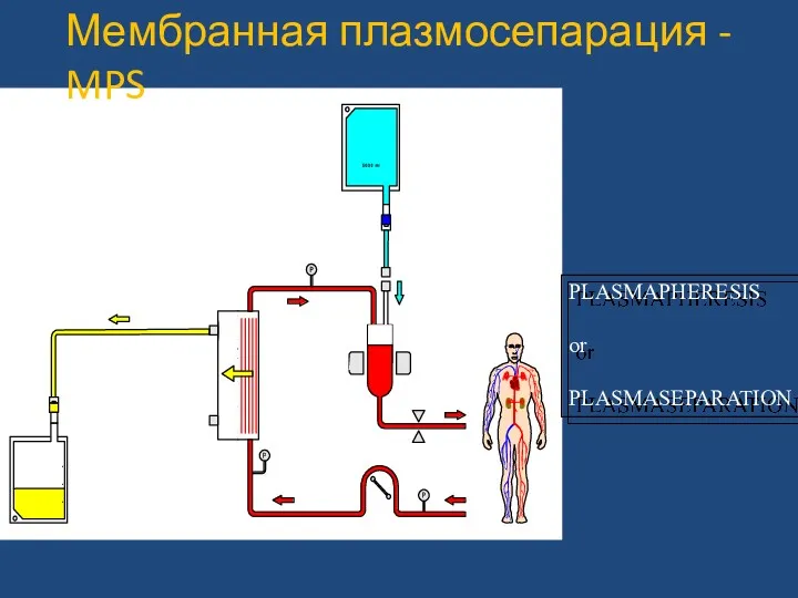 PLASMAPHERESIS or PLASMASEPARATION Мембранная плазмосепарация - MPS