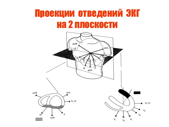 Проекции отведений ЭКГ на 2 плоскости