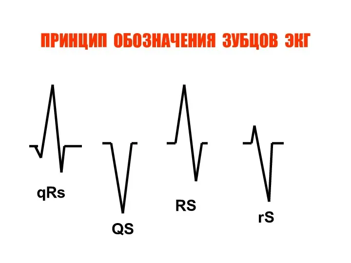 ПРИНЦИП ОБОЗНАЧЕНИЯ ЗУБЦОВ ЭКГ qRs QS RS rS