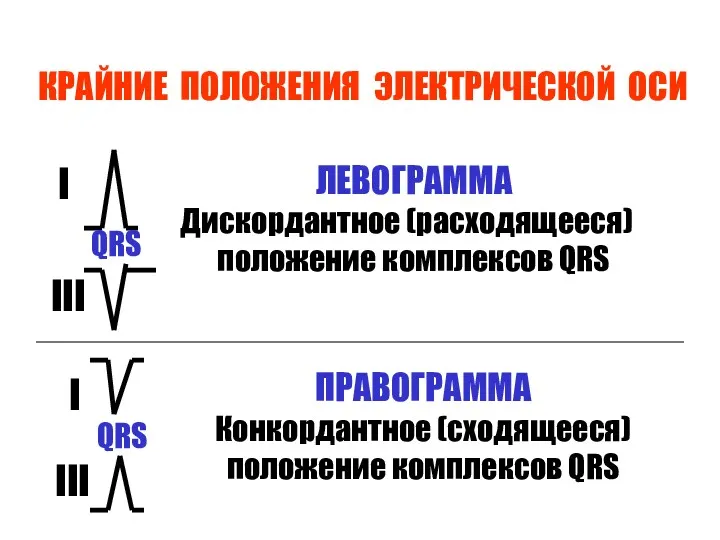 КРАЙНИЕ ПОЛОЖЕНИЯ ЭЛЕКТРИЧЕСКОЙ ОСИ QRS I III QRS I III