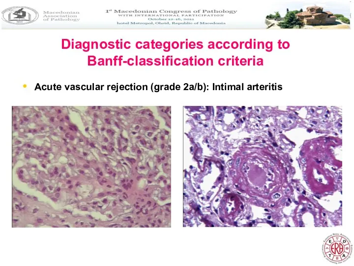 Diagnostic categories according to Banff-classification criteria Acute vascular rejection (grade 2a/b): Intimal arteritis