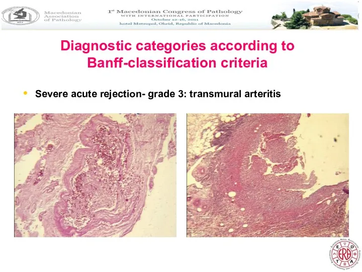 Diagnostic categories according to Banff-classification criteria Severe acute rejection- grade 3: transmural arteritis