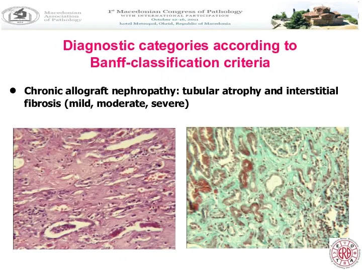 Diagnostic categories according to Banff-classification criteria Chronic allograft nephropathy: tubular