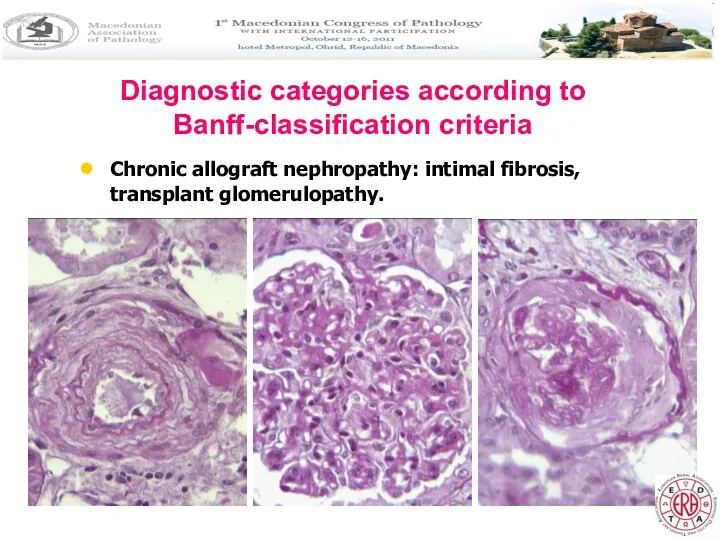 Diagnostic categories according to Banff-classification criteria Chronic allograft nephropathy: intimal fibrosis, transplant glomerulopathy.