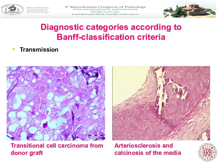 Diagnostic categories according to Banff-classification criteria Transmission Transitional cell carcinoma