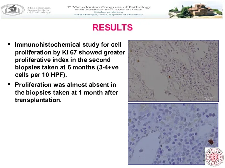 RESULTS Immunohistochemical study for cell proliferation by Ki 67 showed