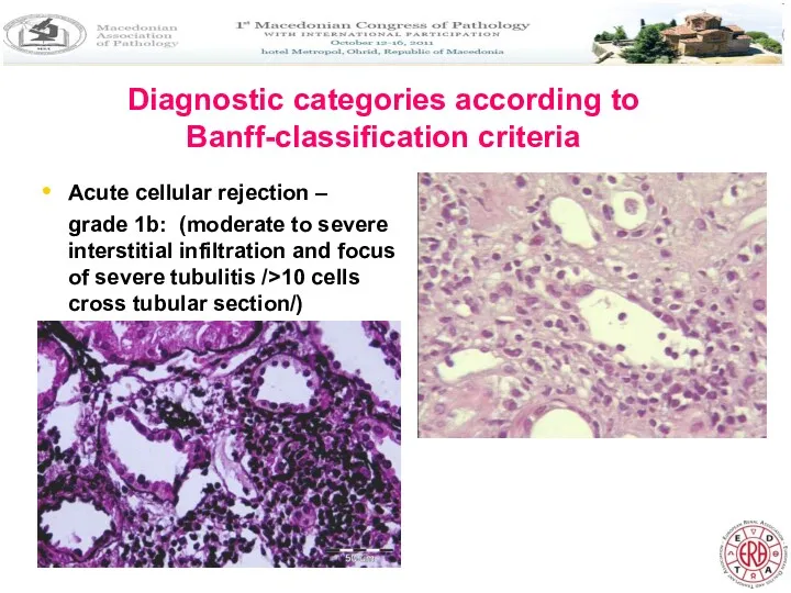 Diagnostic categories according to Banff-classification criteria Acute cellular rejection –