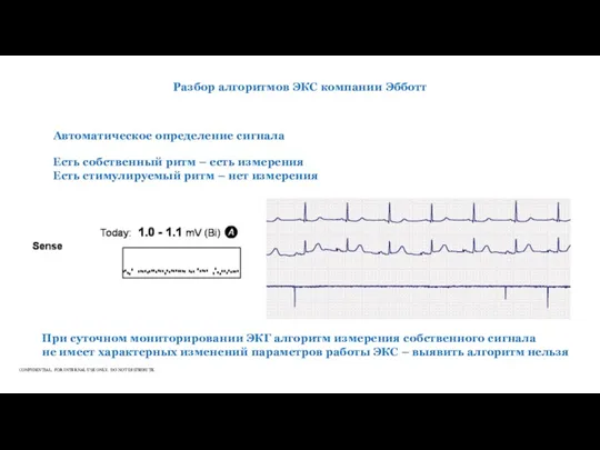 Разбор алгоритмов ЭКС компании Эбботт Автоматическое определение сигнала Есть собственный