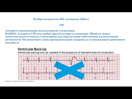 Разбор алгоритмов ЭКС компании Эбботт VIP Алгоритм минимизации желудочковой стимуляции