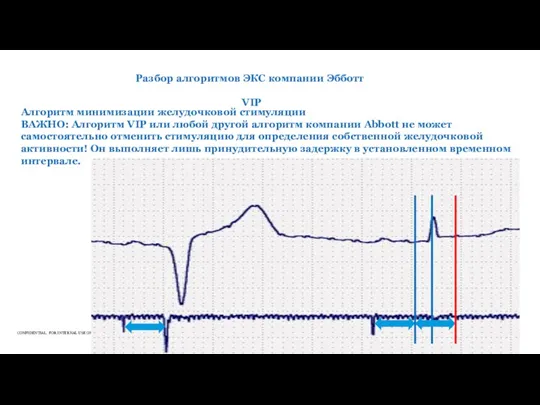 Разбор алгоритмов ЭКС компании Эбботт VIP Алгоритм минимизации желудочковой стимуляции