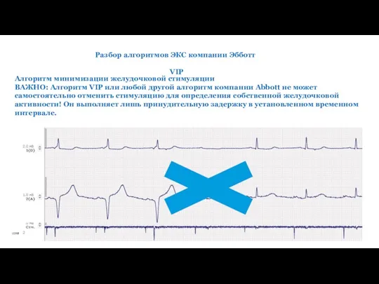 Разбор алгоритмов ЭКС компании Эбботт VIP Алгоритм минимизации желудочковой стимуляции