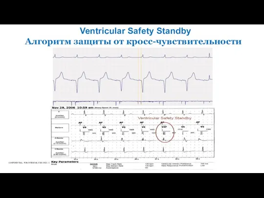 Ventricular Safety Standby Алгоритм защиты от кросс-чувствительности