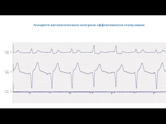 Алгоритм автоматического контроля эффективности стимуляции