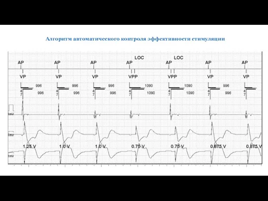 Алгоритм автоматического контроля эффективности стимуляции