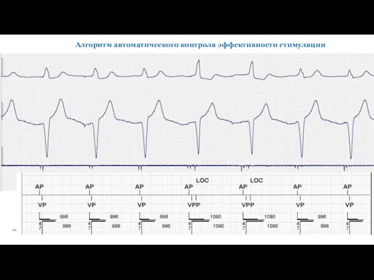Алгоритм автоматического контроля эффективности стимуляции
