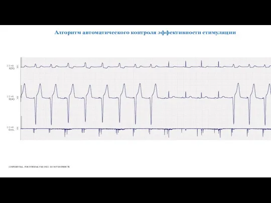 Алгоритм автоматического контроля эффективности стимуляции