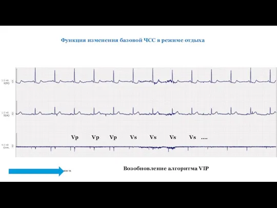 Функция изменения базовой ЧСС в режиме отдыха Возобновление алгоритма VIP