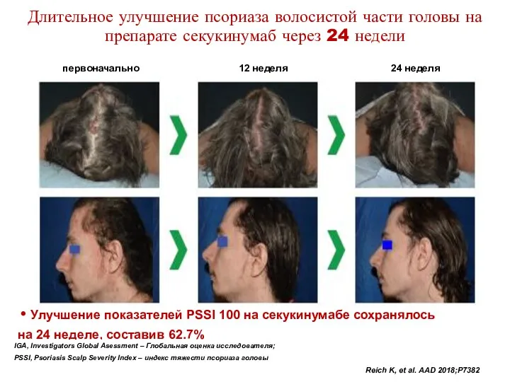 Длительное улучшение псориаза волосистой части головы на препарате секукинумаб через