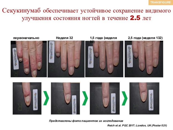 Секукинумаб обеспечивает устойчивое сохранение видимого улучшения состояния ногтей в течение