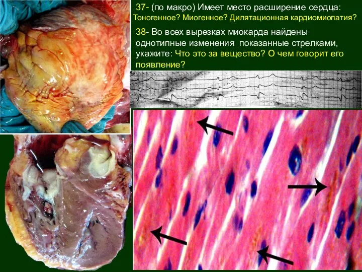 37- (по макро) Имеет место расширение сердца: Тоногенное? Миогенное? Дилятационная