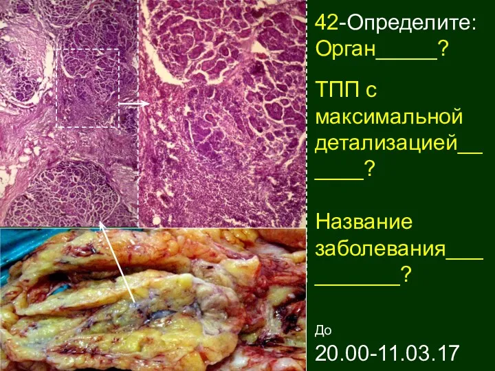 42-Определите: Орган_____? ТПП с максимальной детализацией______? Название заболевания__________? До 20.00-11.03.17