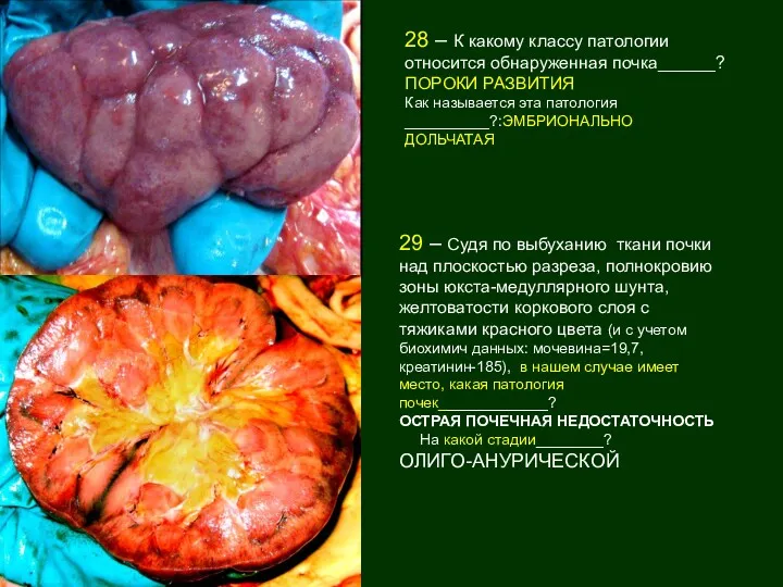 28 – К какому классу патологии относится обнаруженная почка______? ПОРОКИ