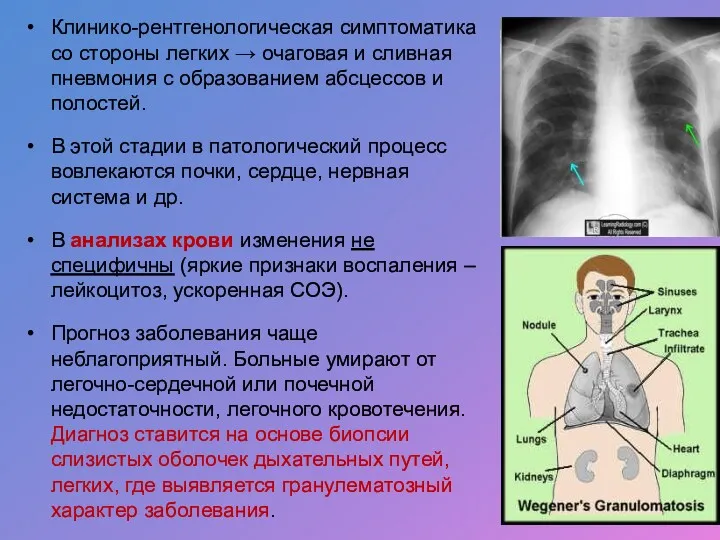 Клинико-рентгенологическая симптоматика со стороны легких → очаговая и сливная пневмония