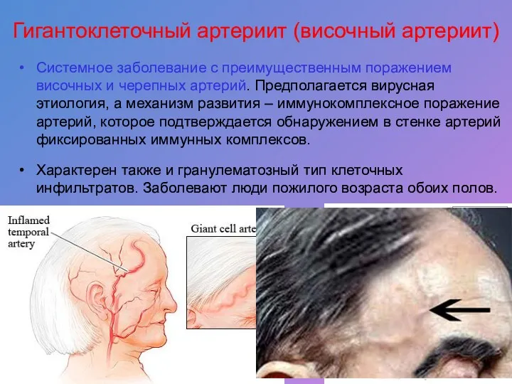 Гигантоклеточный артериит (височный артериит) Системное заболевание с преимущественным поражением височных