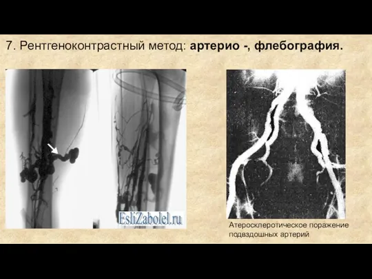 7. Рентгеноконтрастный метод: артерио -, флебография. Атеросклеротическое поражение подвздошных артерий