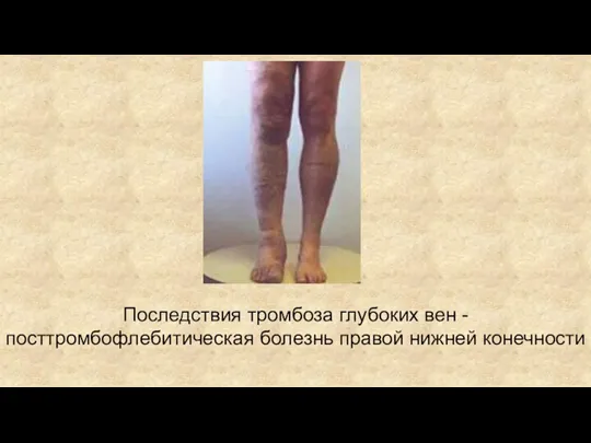 Последствия тромбоза глубоких вен - посттромбофлебитическая болезнь правой нижней конечности