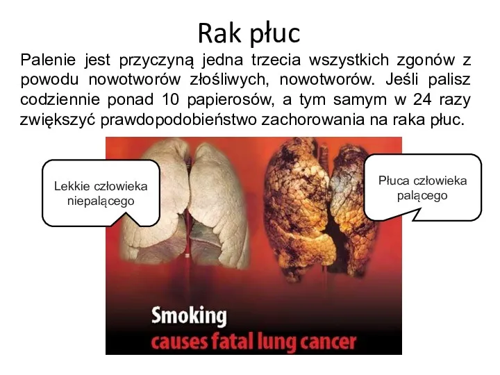 Rak płuc Palenie jest przyczyną jedna trzecia wszystkich zgonów z