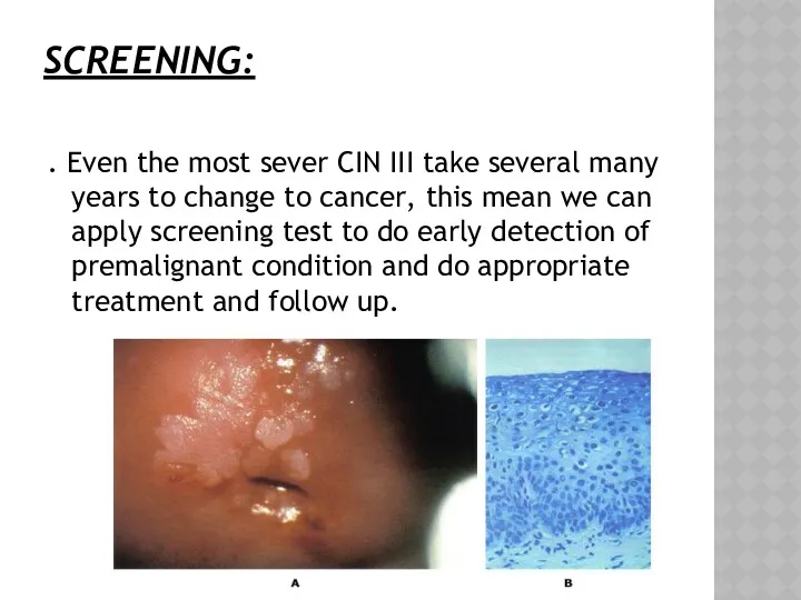 SCREENING: . Even the most sever CIN III take several