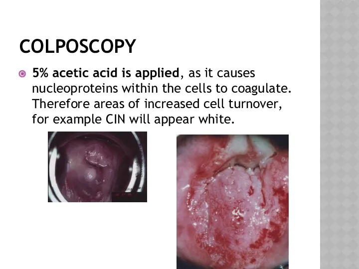 COLPOSCOPY 5% acetic acid is applied, as it causes nucleoproteins