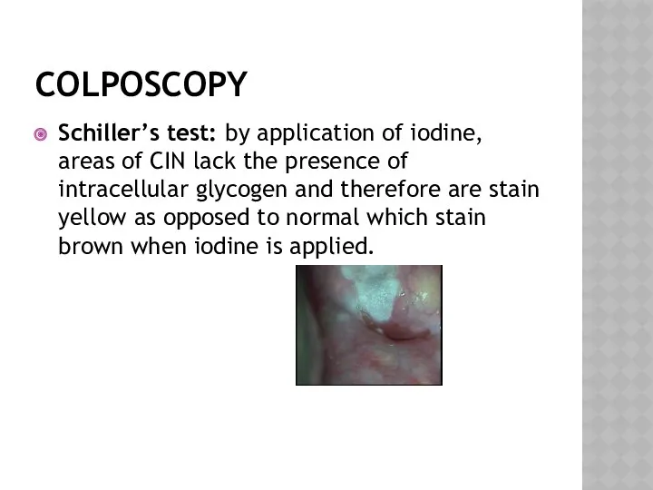 COLPOSCOPY Schiller’s test: by application of iodine, areas of CIN