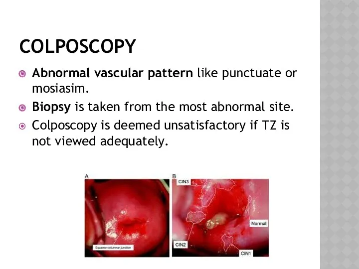 COLPOSCOPY Abnormal vascular pattern like punctuate or mosiasim. Biopsy is