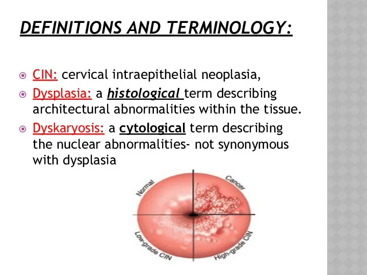 DEFINITIONS AND TERMINOLOGY: CIN: cervical intraepithelial neoplasia, Dysplasia: a histological