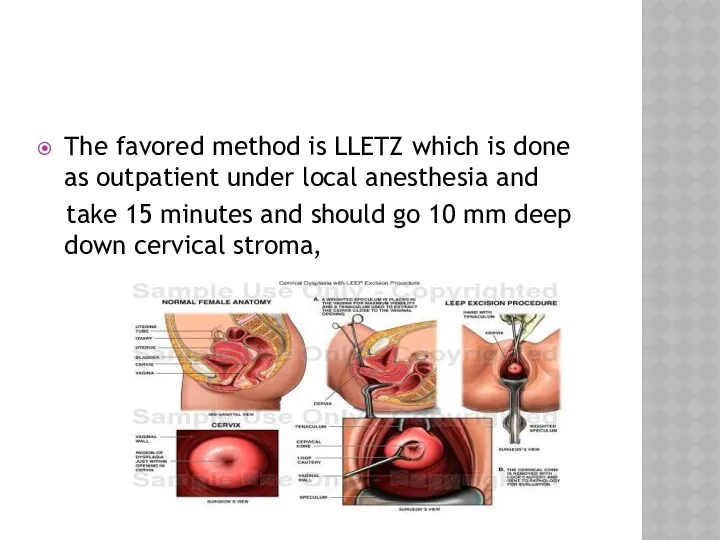 The favored method is LLETZ which is done as outpatient