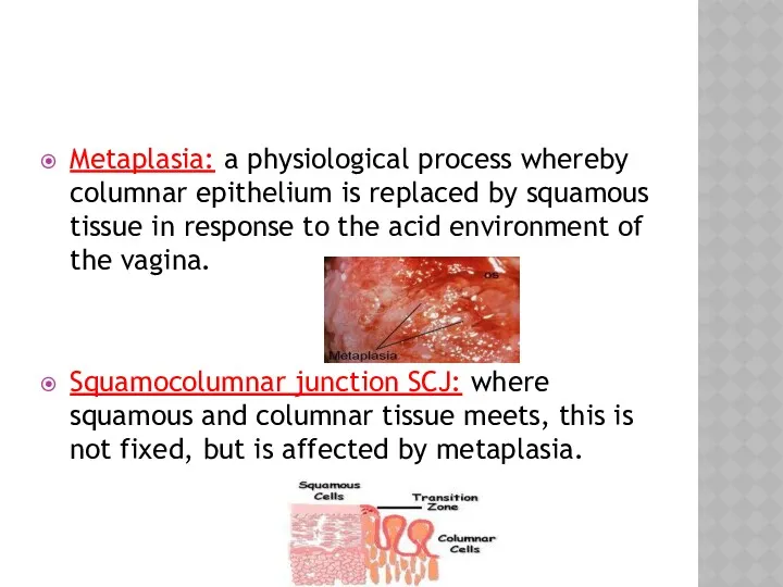 Metaplasia: a physiological process whereby columnar epithelium is replaced by