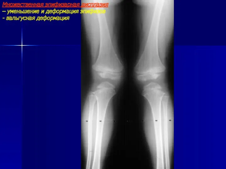 Множественная эпифизарная дисплазия – уменьшение и деформация эпифизов - вальгусная деформация