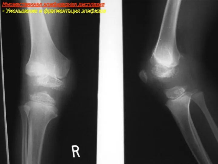 Множественная эпифизарная дисплазия - Уменьшение и фрагментация эпифизов