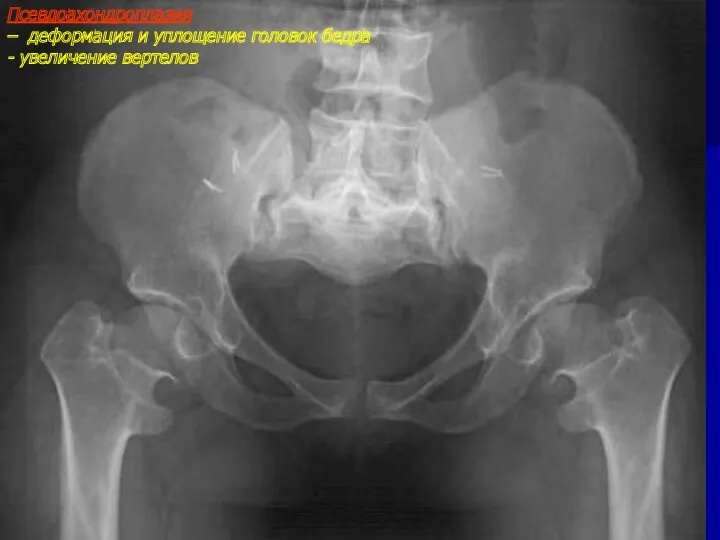 Псевдоахондроплазия – деформация и уплощение головок бедра - увеличение вертелов