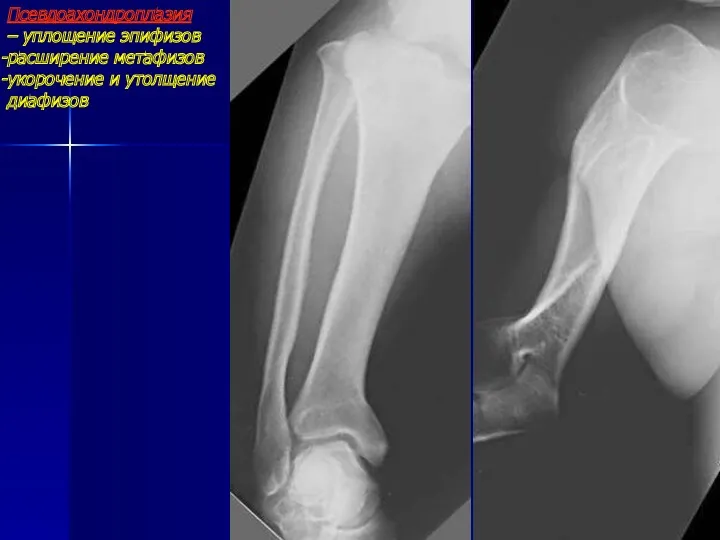Псевдоахондроплазия – уплощение эпифизов расширение метафизов укорочение и утолщение диафизов