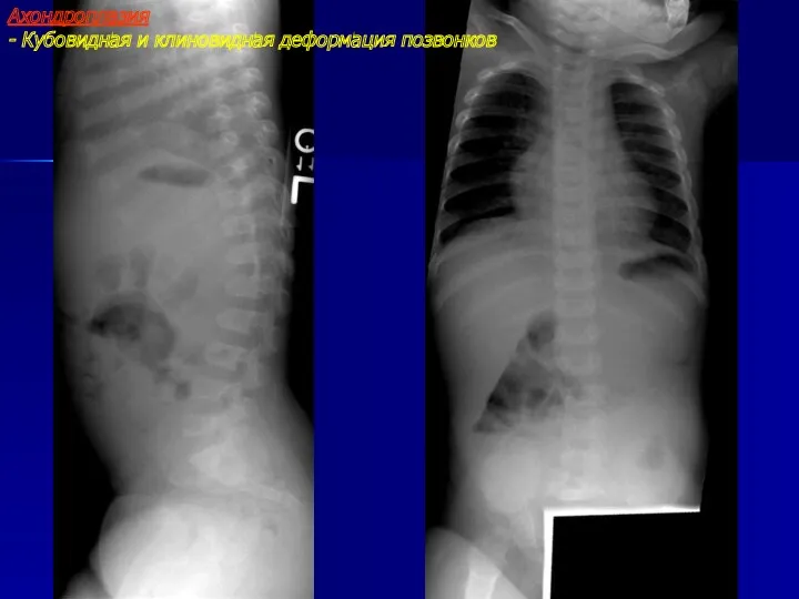 Ахондроплазия - Кубовидная и клиновидная деформация позвонков