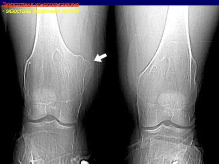 Экзостозная хондродисплазия - экзостозы бедренных костей