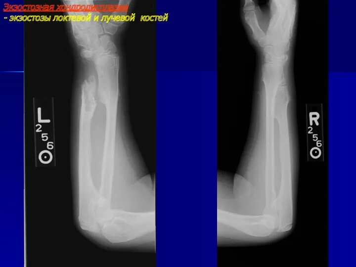 Экзостозная хондродисплазия - экзостозы локтевой и лучевой костей