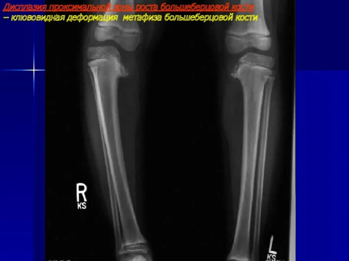 Дисплазия проксимальной зоны роста большеберцовой кости – клювовидная деформация метафиза большеберцовой кости