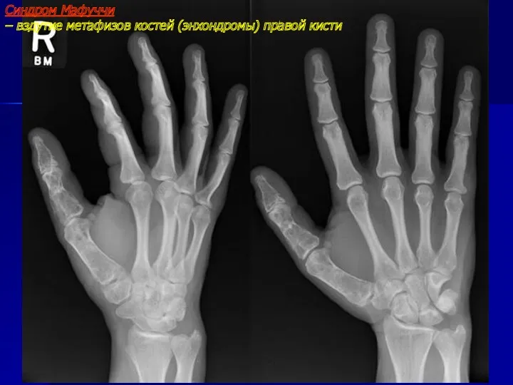 Синдром Мафуччи – вздутие метафизов костей (энхондромы) правой кисти